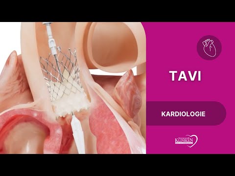 TAVI - Transcatheter Aortic Valve Implantation