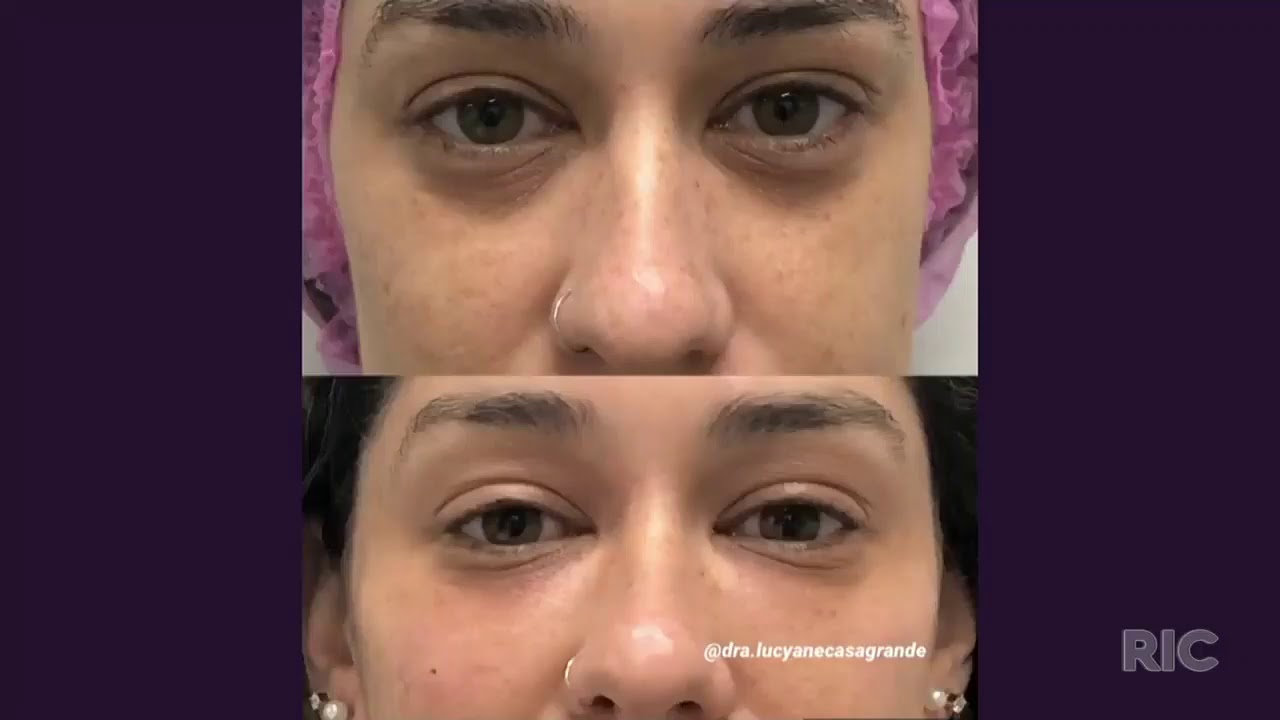 Plasma gel: você mais jovem e de forma natural