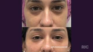 Plasma gel: você mais jovem e de forma natural