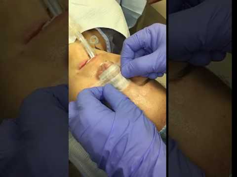 Open rhinoplasty 69