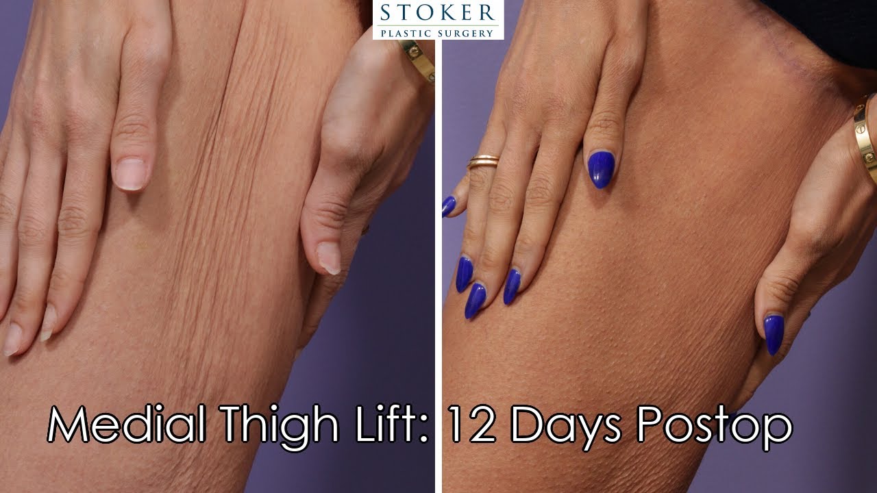 Weight Loss Thigh Lift Before And After