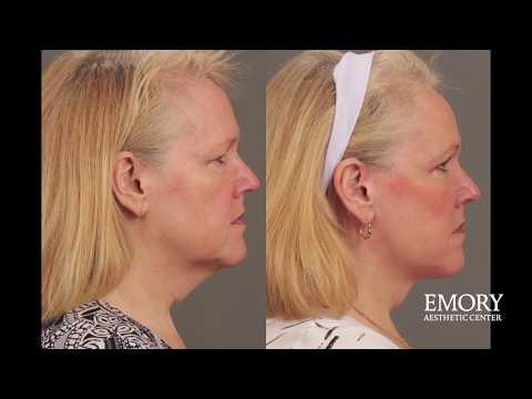 1st YouTube video about how long does a facelift last