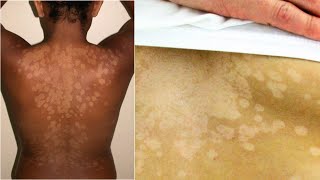 What is Tinea Versicolor? Causes, Treatment