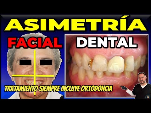 ASIMETRÍA Facial & Dental: ¿Cómo tratarlas con Ortodoncia?