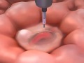 NEJM Procedure: Endoscopic Management of Acute Bleeding from a Peptic Ulcer