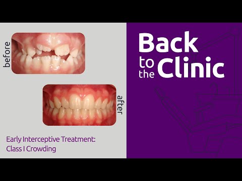 Early Interceptive Treatment: Class I Crowding  - Back to the Clinic #009