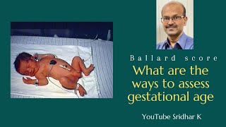 What are the ways to assess gestational age in preterm babies? Dr Sridhar K
