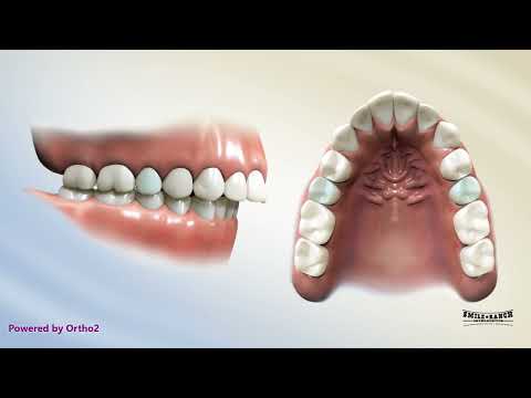 Upper 2nd Bicuspid Extraction