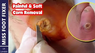 The Most Painful & Soft Corn On Pinky TOE | Remove Painful Old Corn From Feet