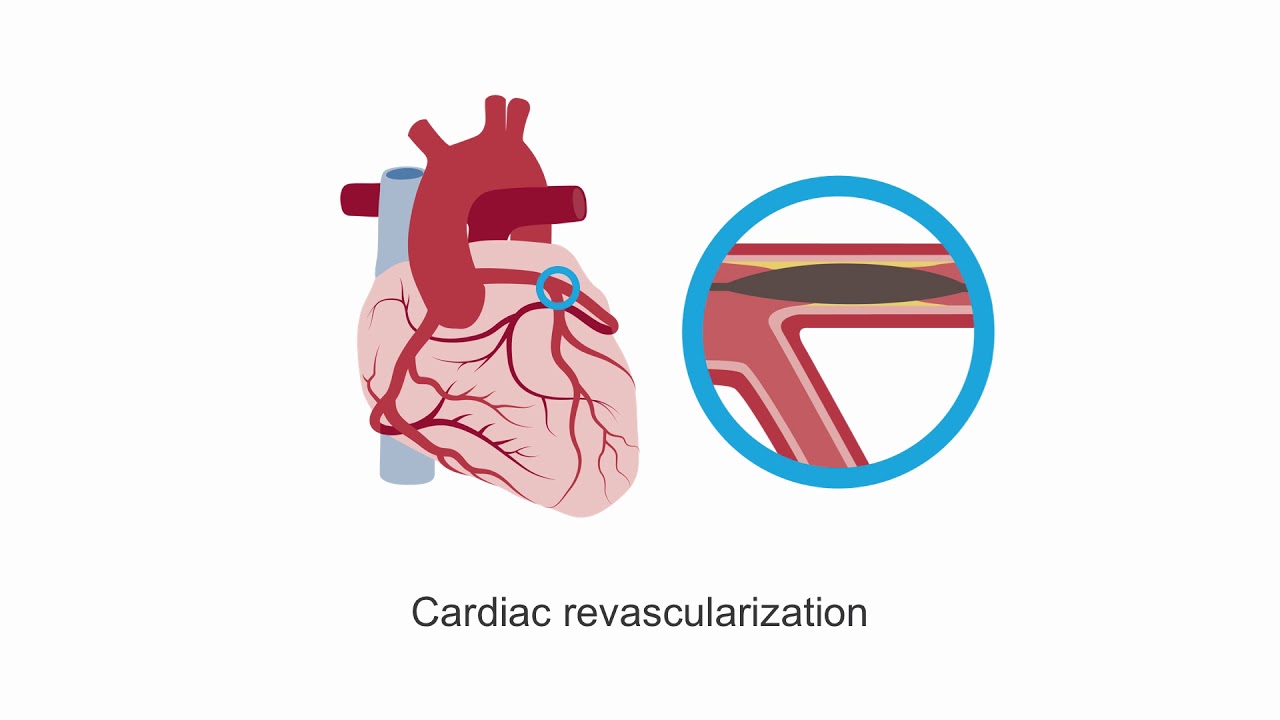 Considering mechanical circulatory support