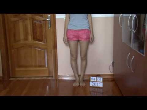 Reumatoidalne deformacje stóp 1 palec Palucha koślawego w kod ICD 10