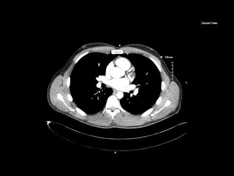 Zyste des Knies Spondylitis Wunde Seite mit der linken Seite seines Rückens, welchen Arzt