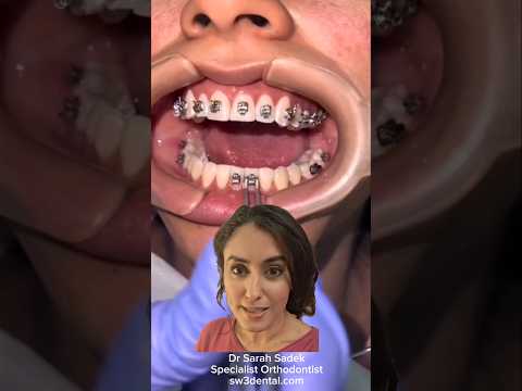 What happens at your brace fitting?! #shorts #braces