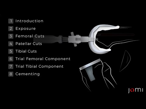 Procedure Steps: Posterior Cruciate-Retaining Total Knee Arthroplasty