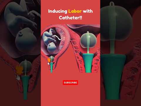 Induction Process #shorts #share #pregnancy #foryou