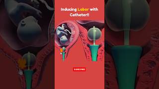 Induction Process #shorts #share #pregnancy #foryou