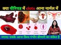 Why Do Clots Come During Periods How Many Clots Is Normal What To Do If There Is Excessive Blee