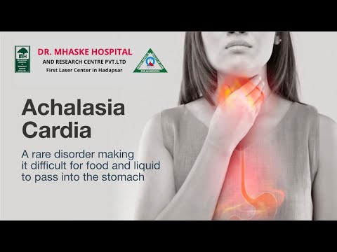 Heller&rsquo;s cardiomyotomy with dor&rsquo;s fundoplication - Achalasia cardia by - Dr Chetan Mhaske