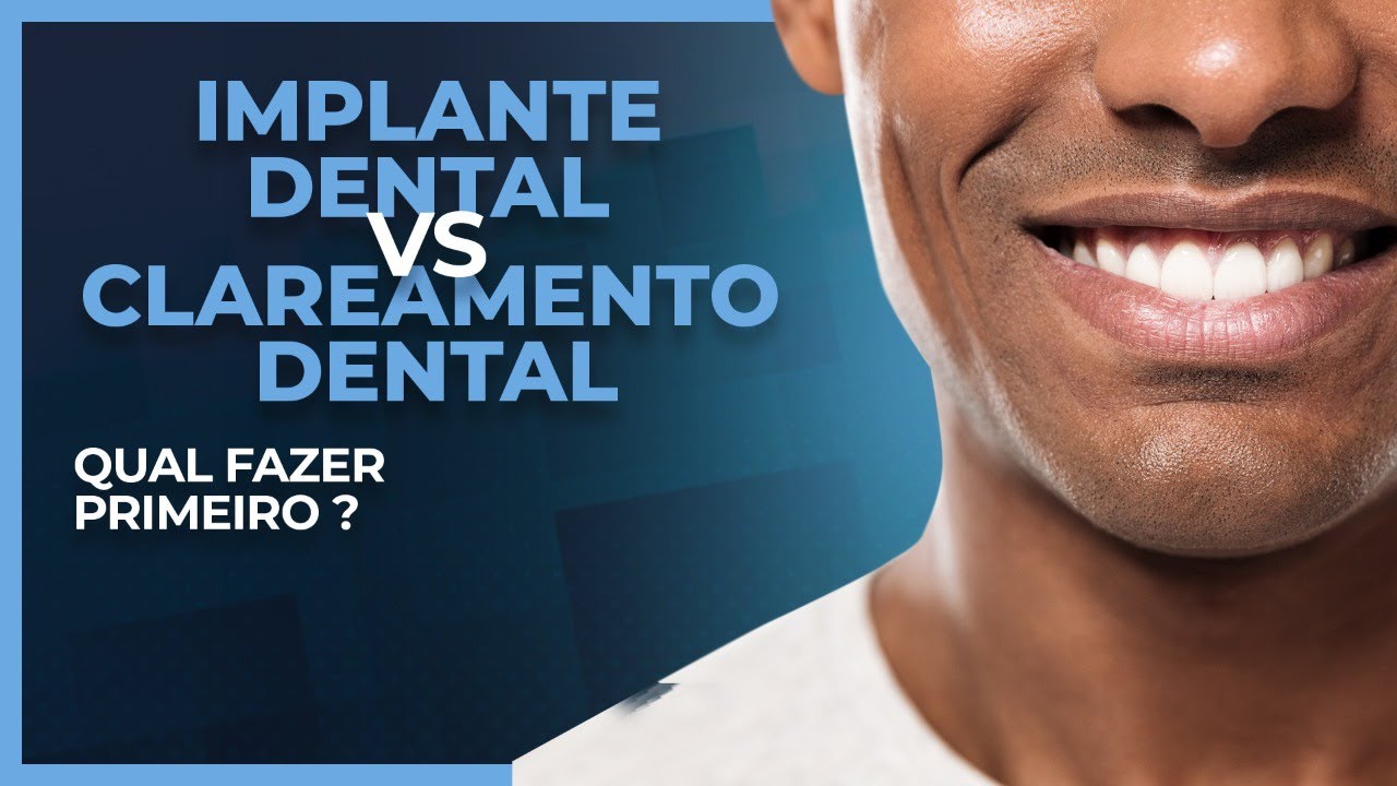 IMPLANTE DENTÁRIO X CLAREAMENTO DENTAL - QUAL FAZER PRIMEIRO?