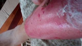 Peeling off skin after a burn to avoid massive infection (At home dermabrasion skin peel)