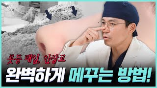 코 수술 후 콧등패임 되돌릴 수 있을까? I 브이엔성형외과 I