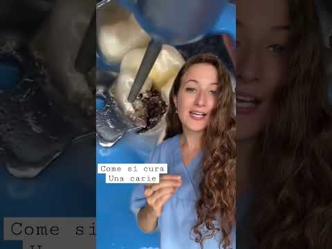 Carie: come si curano è come fare prevenzione #dentista #igienistadentale #salute #bocca