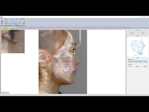 How to: Manual Landmark with WillCeph