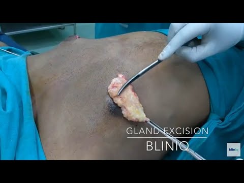 Patient Recovery Case — Video 15 (Gynecomastia)