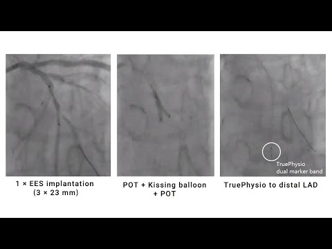 Post-PCI FFR and pullback assessment for bifurcation lesion in multi-vessel disease