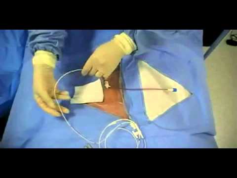 Insertion of Transvenous Pacemaker