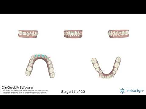 My ClinCheck – A Straight Smile