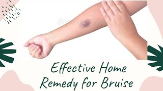 Bruise Removal Home Remedy | Easy Cure For Bruise At Home | Heal Bruises Quickly | Dr. Akhila Vinod