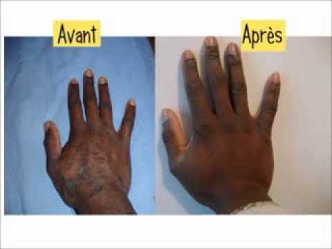 comment soigner psoriasis visage