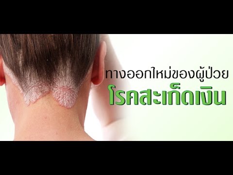 ครีมยาปฏิชีวนะสำหรับกลาก รุ่งอรุณในความคิดเห็นของครีมโรคสะเก็ดเงิน