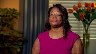 Boyfriend Threw Acid on Woman&#39;s Face When She Tried Breaking Up with Him