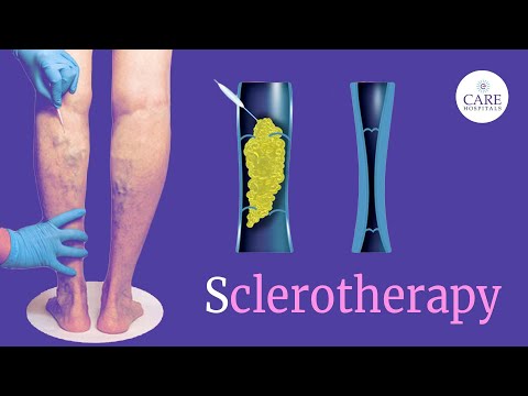Say Goodbye to Varicose Veins with Sclerotherapy | Animated Varicose Vein Treatment Guide