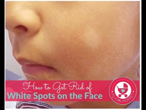 5 Ways To Get Rid Of White Spots On The Face