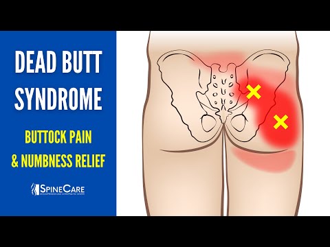 FAST RELIEF: Dead Butt Syndrome (Buttock Pain, Weakness & Numbness Fix)