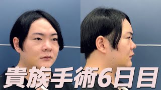 Dr.崔の貴族手術6日目 経過報告