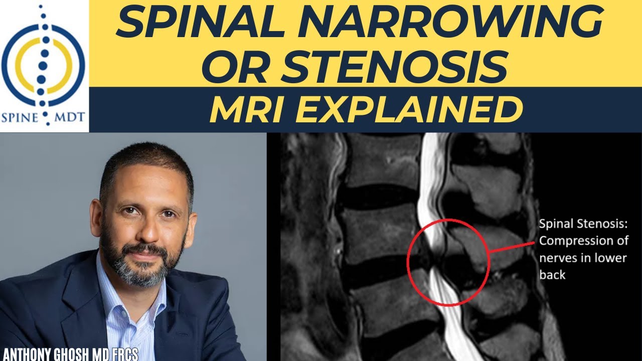 What Is Spinal Narrowing? Spine Surgeon Explains Stenosis