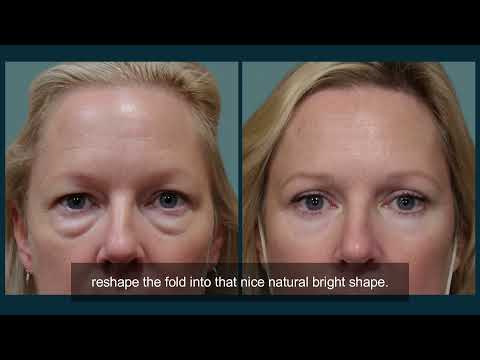 Upper Eyelid Blepharoplasty Surgery Explained