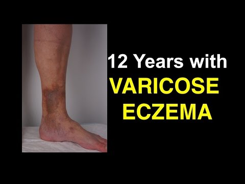 Rimedi di gente da neurodermatitis Dermatite di atopic a unghie di adulti