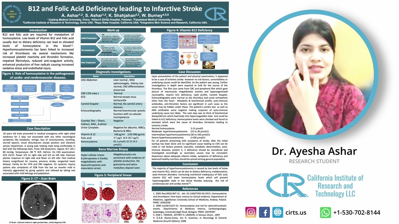 B12 and Folic Acid Deficiency leading to Infarctive Stroke - Dr Ayesha Ashar