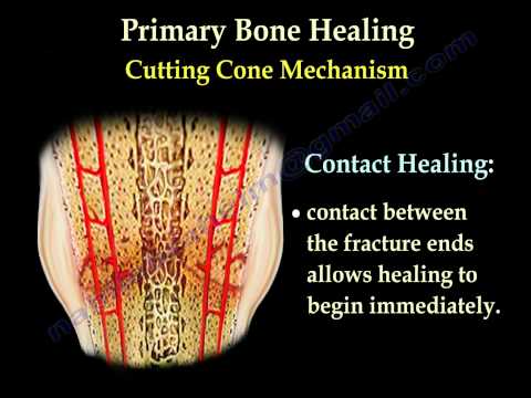 Fracture Healing Part 2  - Everything You Need to Know - Dr. Nabil Ebraheim