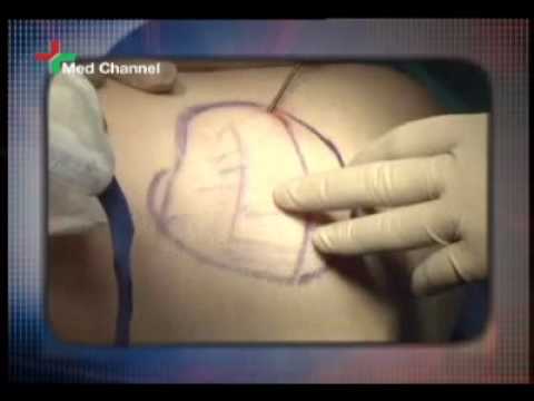 Liposuction,Greece-UK-Cyprus- Dr N. Kapositas,M.D,PhD,Global Plastic Surgery