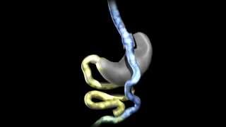 preview picture of video 'Gastric Bypass animation'