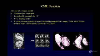 Imaging in adult congenital heart disease using cardiac MRI – Dr Sylvia Chen