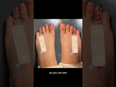 Short Toe Receives G.E.N.I.U.S. Metatarsal Lengthening By Dr. Khosroabadi!
