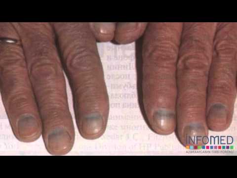 Dırnaqda ləkələr hansı xəstəliklərdən xəbər verir?