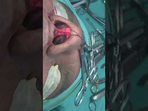 Reconstructive Rhinoplasty- Real Surgery Recording